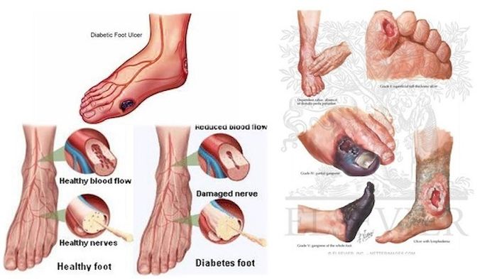 Bất cứ bộ phận nào trên cơ thể có dấu hiệu hoại tử đều gây ra nhiều phiền toái cho người bệnh.