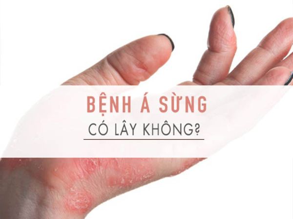 Bệnh á sừng là một bệnh  da liễu khá phổ biến, tuy nhiên bệnh không  lây  từ người bệnh sang người bình thường