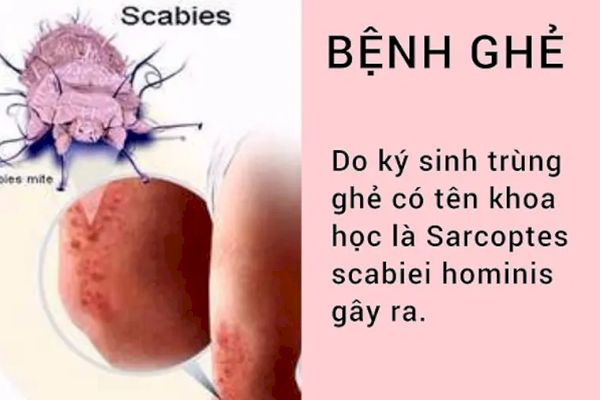 Bệnh ghẻ gây nên là do sự xâm nhập và sinh sôi của ký sinh trùng ghẻ Sarcoptes scabiei hominis