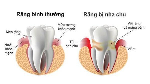 Bệnh nha chu là bệnh của các tổ chức ở xung quanh răng.