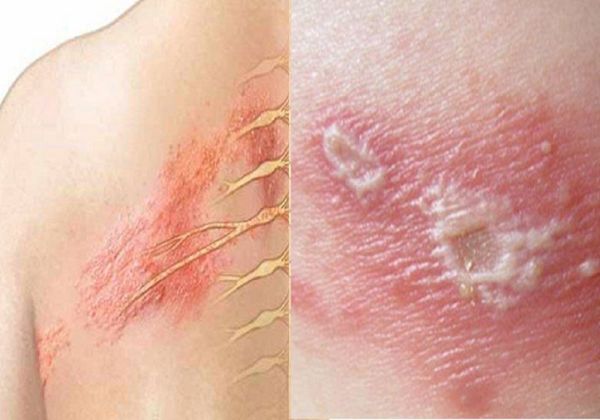 Bệnh zona là kết quả của sự tái hoạt động của vi rút herpes zoster