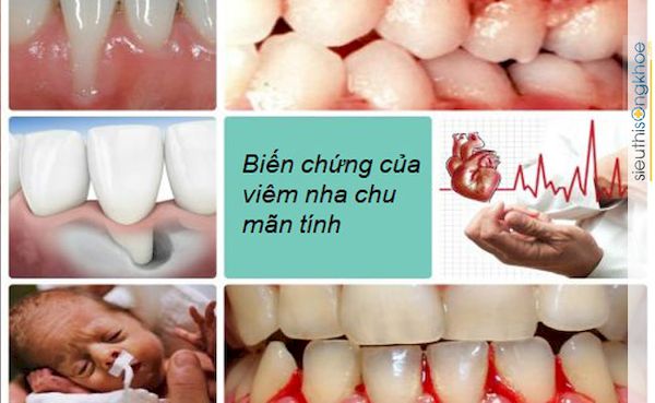 Biến chứng của bệnh nha chu 