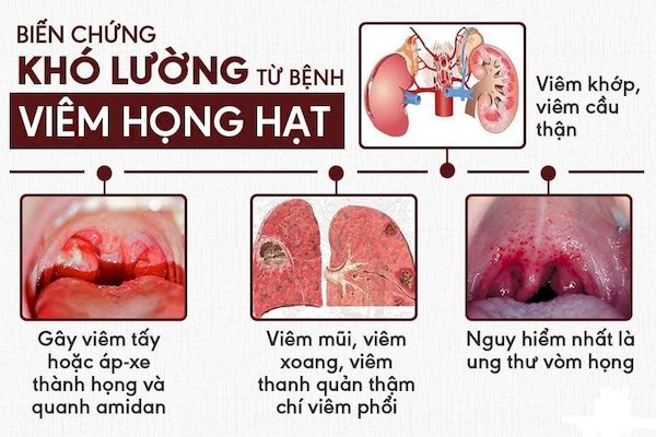 Biến chứng của bệnh viêm họng