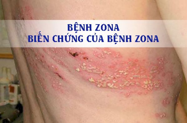 Biến chứng của bệnh zona thần kinh