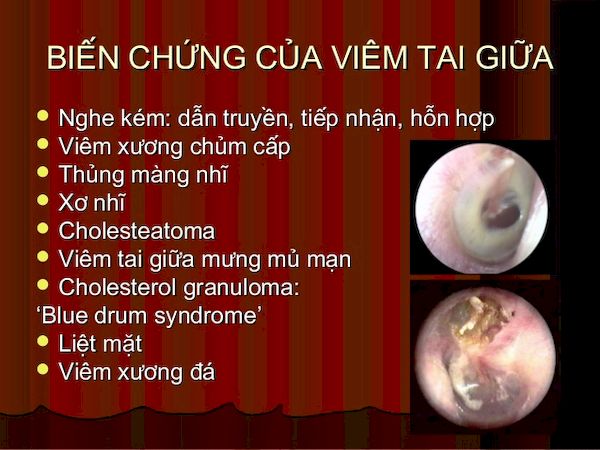 Biến chứng viêm tai giữa