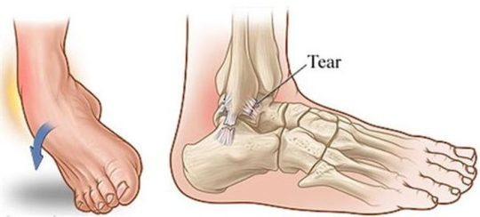 Bong gân là tình trạng dây chằng (phần nối giữa 2 hoặc nhiều xương xung quanh 1 khớp) bị căng quá mức hoặc rách gây ra đau