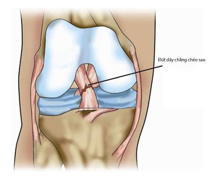 Các biến chứng do giãn dây chằng cần đặc biệt lưu ý