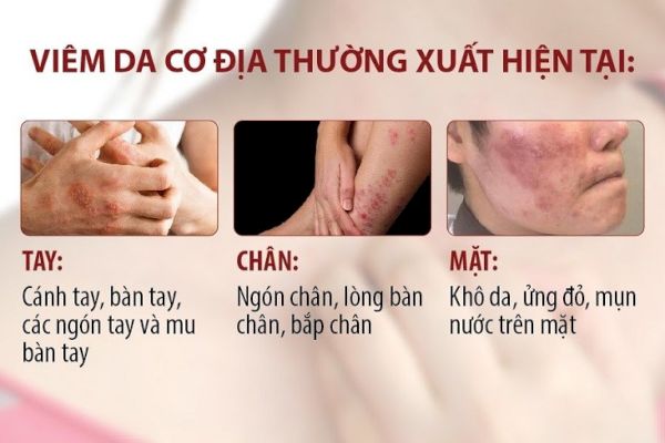 Các giai đoạn bệnh viêm da cơ địa_1