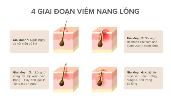 Các giai đoạn của viêm lỗ chân lông