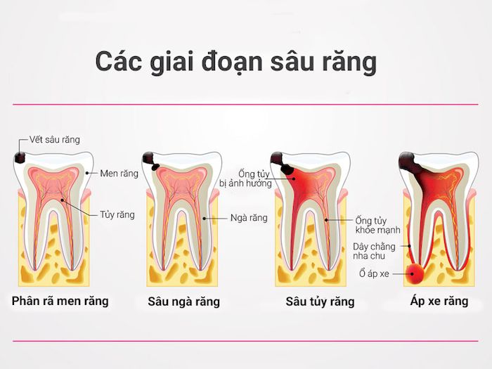 Các giai đoạn phát triển của sâu răng