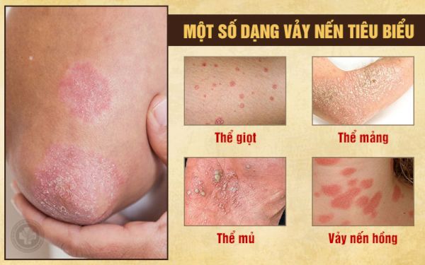 Một số dạng vảy nến phổ biến