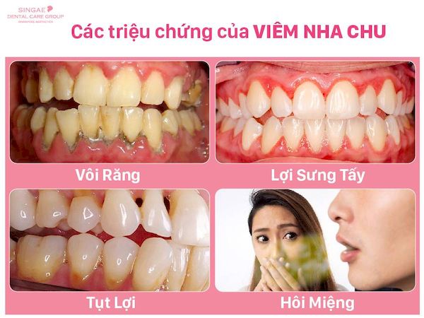 Các triệu chứng của bệnh nha chu