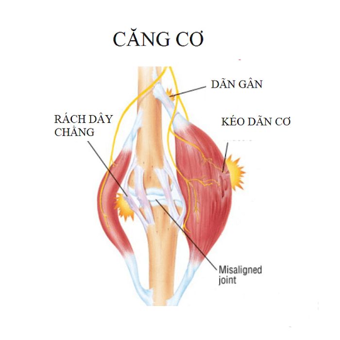 Căng cơ ( hay còn được với tên tiếng anh là Muscle Strain) đây là hiện tượng cơ bị kéo căng, thậm chí là bị rách