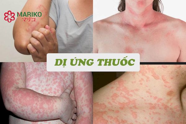 Mẫn cảm với thành phần của thuốc là gì?