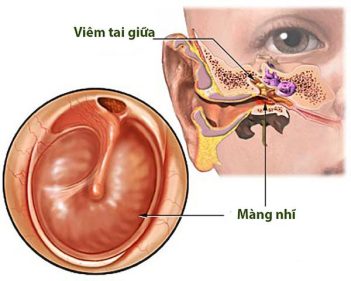 Chẩn đoán và điều trị bệnh viêm tai giữa