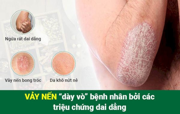 Dấu hiệu của bệnh vảy nến chính là da bị thương tổn và đóng thành dạng vảy trắng