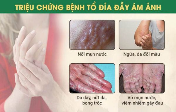 Dấu hiệu và triệu chứng của bệnh tổ đỉa có thể kéo dài trong vài tuần