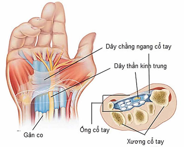 Giãn dây chằng cổ tay