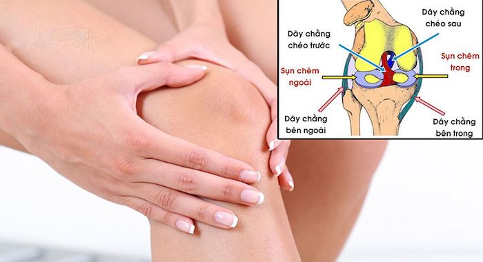 Giãn dây chằng khớp gối