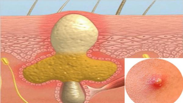 Mụn nhọt là tình trạng nhiễm trùng ở nang lông, sau đó các tổn thương viêm lan rộng