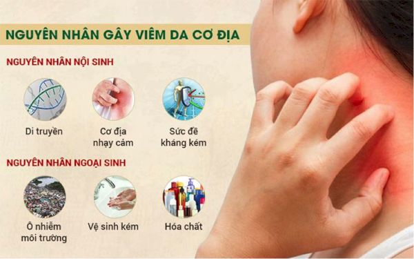 Nguyên nhân gây bệnh viêm da cơ địa