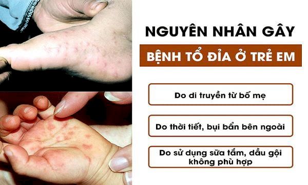 Nguyên nhân mắc bệnh tổ đỉa