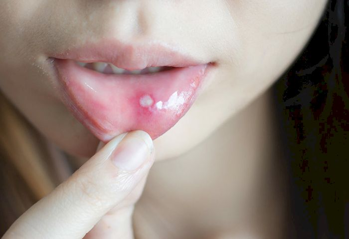 Làm thế nào để ngăn ngừa tái phát nhiệt miệng sau khi điều trị thành công?
