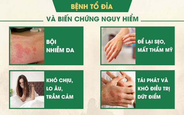 Những biến chứng cực kỳ nguy hiểm của bệnh tổ đỉa