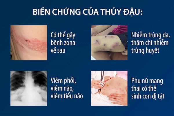 Những biến chứng nghiêm trọng của bệnh thủy đậu để lại