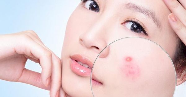 Những cách điều trị mụn nhọt