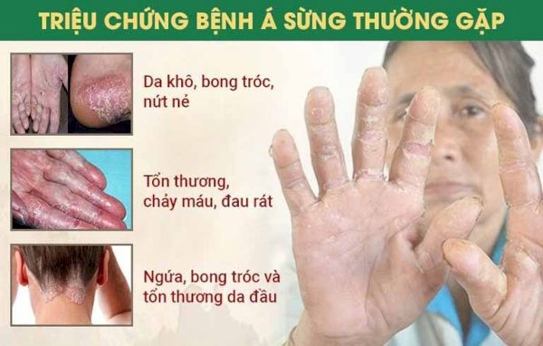 Những dấu hiệu và triệu chứng của bệnh á sừng