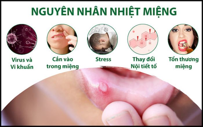 Những nguyên nhân gây tình trạng nhiệt miệng