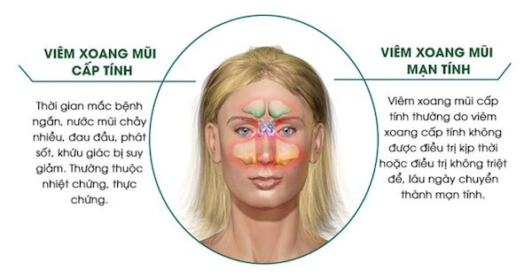 Phân loại viêm xoang dựa trên bệnh lý có lợi cho việc quản lý bệnh nhân.