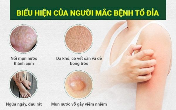 Phân loại bệnh chàm tổ đỉa