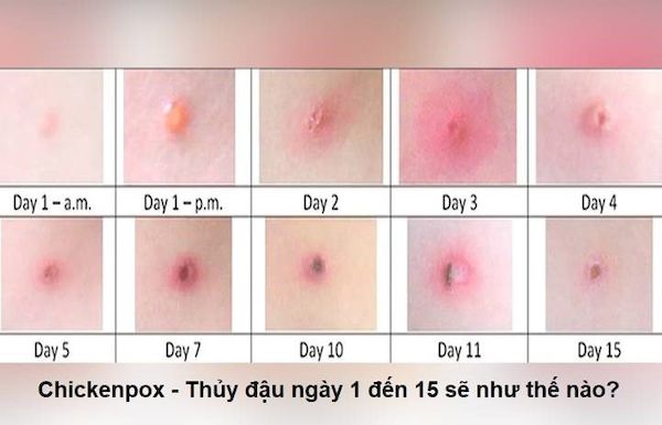 Qúa trình các giai đoạn của bệnh thủy đậu