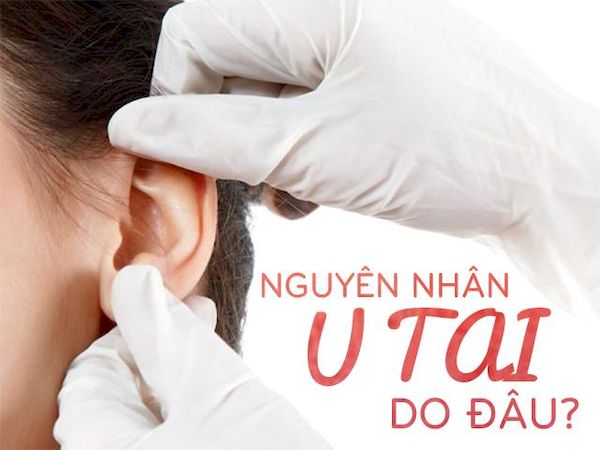 Tiếng ồn lớn là nguyên nhân phổ biến gây mất thính lực do tiếng ồn