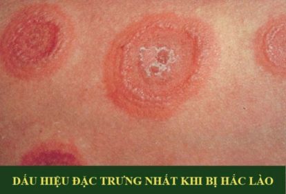 Triệu chứng của bệnh hắc lào