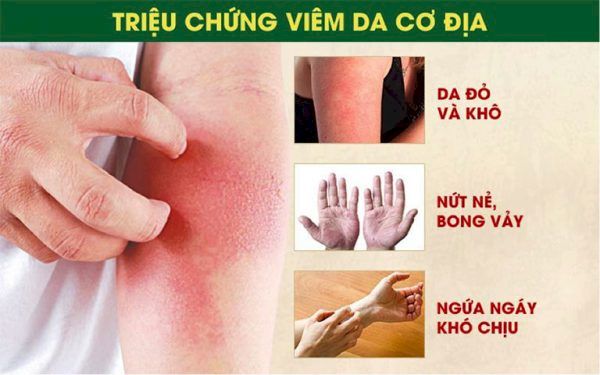 Triệu chứng của bệnh viêm da cơ địa