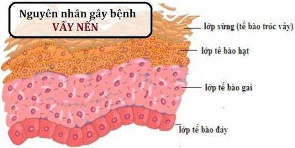 Vảy nến là một triệu chứng tự miễn của cơ thể, bệnh không phải do vi khuẩn, vi rút hay dị nguyên ngoại lai gây ra