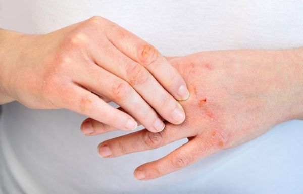 Viêm da cơ địa trong tiếng Anh gọi là Atopic Dermatitis hay còn gọi là chàm thể tạng, chàm cơ địa, địa y đơn thuần mãn tính…