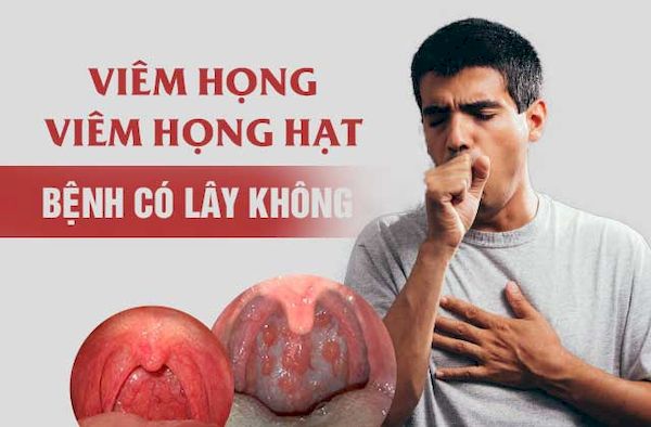 Viêm họng có lây được không thì đối với cả 2 loại viêm họng do virus và vi khuẩn đều có khả năng  lây truyền được từ người này sang người khác