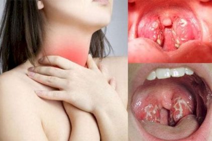 Viêm họng là hiện tượng lớp niêm mạc của cổ họng bị viêm nhiễm hoặc tổn thương