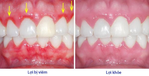 Viêm lợi là tình trạng nướu bị viêm, thường là do nhiễm trùng vi khuẩn