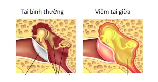 Viêm tai giữa là một nhóm các bệnh lý về tai giữa, là tình trạng tổn thương và viêm nhiễm xảy ra ở tai giữa do sự sinh sôi và phát triển của vi khuẩn