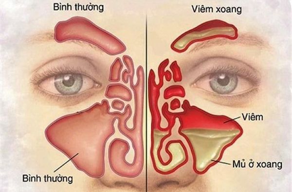 Viêm xoang là tình trạng nhiễm trùng và viêm một hoặc nhiều xoang do một xoang bị tắc.