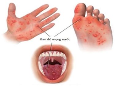 Bệnh tay chân miệng là bệnh truyền nhiễm do một nhóm vi rút đường ruột gây ra