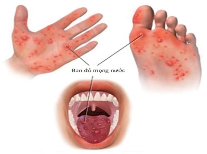 Bệnh tay chân miệng là bệnh truyền nhiễm do một nhóm vi rút đường ruột gây ra