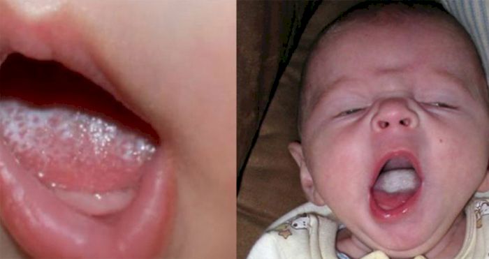 Dấu hiệu nhận biết trẻ sơ sinh bị nấm lưỡi