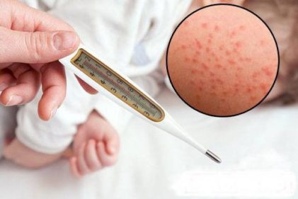 Sởi là  bệnh truyền nhiễm cấp tính với các biểu hiện như sốt, nổi mẩn đỏ trên da, sổ mũi, ho, đỏ mắt…