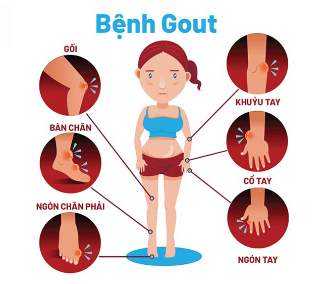 benh-gout-2